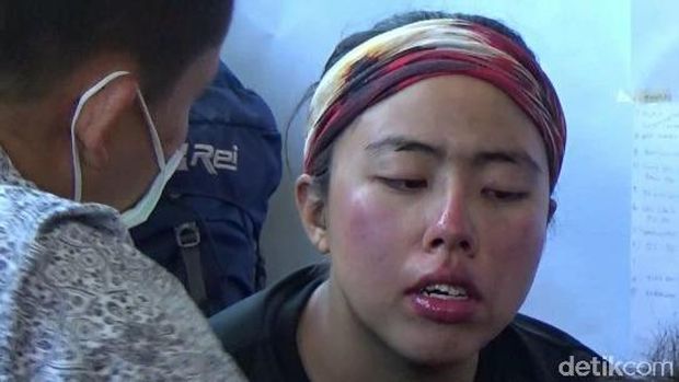 Salah satu pendaki asal Singapura yang wajahnya terbakar