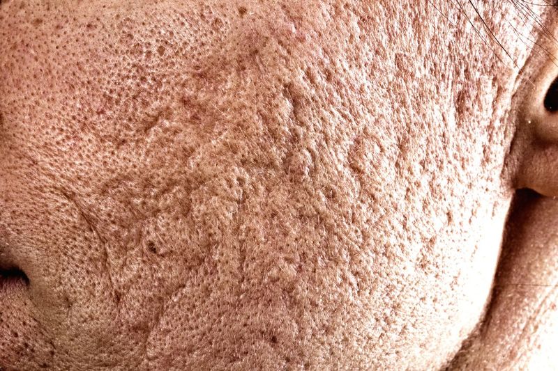 Close up of problematic skin with deep acne scars on cheek