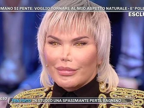 Ngeri! Hidung Pria Ini Jadi Menyusut Setelah 72 Kali Operasi Plastik 