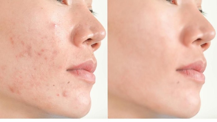 Close up of problematic skin with deep acne scars on cheek