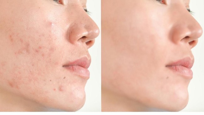 Jerawat dan Kulit Kusam Bisa Diatasi dengan Masker Kulit Pisang Ini Jerawat dan Kulit Kusam Bisa Diatasi dengan Masker Kulit Pisang Ini