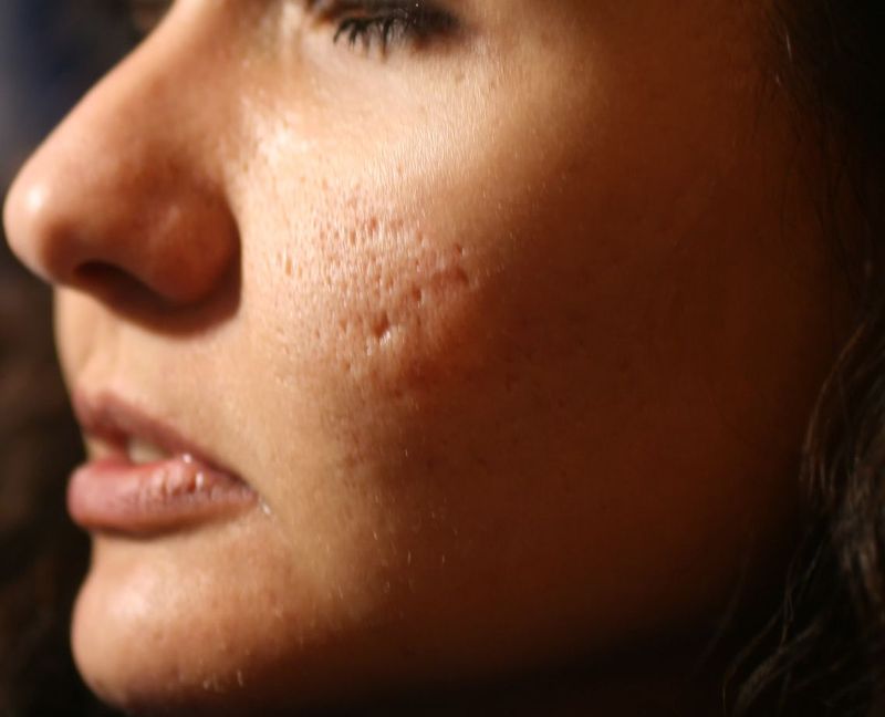 Close up of problematic skin with deep acne scars on cheek