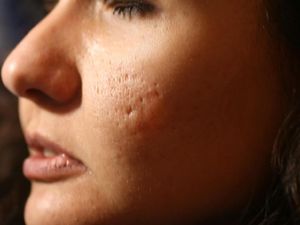 Inovasi Terapi Laser & Skin Booster Terbaru, Hilangkan Bopeng Secara Permanen