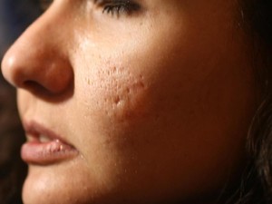 Inovasi Terapi Laser & Skin Booster Terbaru, Hilangkan Bopeng Secara Permanen