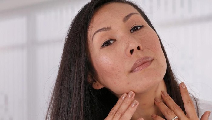 Skin Problems : Asian woman covering pimple scars and acne with powder foundation