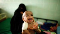 Ini potret miris balita yang kekurangan gizi, di salah satu Feeding Centre atau tempat pembagian makanan yang ada di kota Taiz. Foto: Istimewa