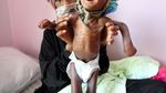 Potret Miris Anak-anak di Yaman yang Kelaparan dan Kekurangan Makanan