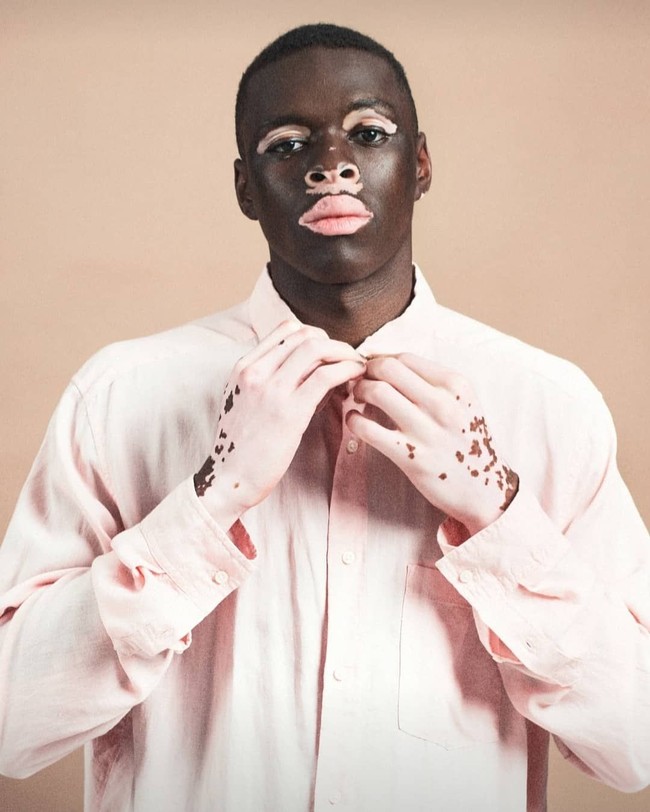 Moostapha merupakan model dengan kondisi kulit vitiligo. Vitiligo merupakan kondisi di mana kulit kehilangan pigmen atau melanin. Alhasil, warna kulit jadi tidak rata dan terlihat belang-belang. Pria asal Afrika Selatan ini membuat agensi model tertarik padanya karena kondisi kulitnya yang unik itu. Foto: Dok. Instagram