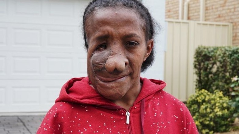 Perempuan Asal Jayapura Natalia Apaseray Operasi Tumor Wajah di Sydney Perempuan Asal Jayapura Natalia Apaseray Operasi Tumor Wajah di Sydney