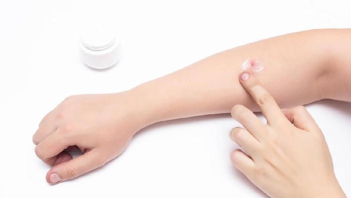 Man smears a medical hormone ointment with a gray red sore pimple on his hand, white background, copy space