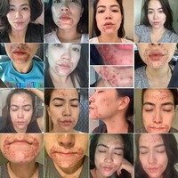 Kondisi kulit misterius tersebut pun mengharuskannya minum obat dan mencari pengobatan terbaik. Aku sudah minum enam antibiotik selama beberapa bulan ini dan menggunakan banyak resep topikal di wajahku yang tak terhitung. Aku tidak pernah berjerawat sebelumnya tapi aku kadang mengalami eksim ketika kecil, tulis Frances di Instagram. Foto: Instagram @franceswangtv