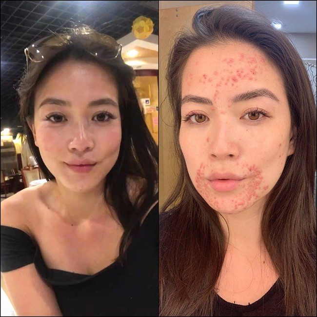 Dikatakan jika kondisi itu misterius atau tak diketahui apa penyebabnya. Namun selama lima bulan terakhir, tiba-tiba saja wajah cantik Frances ditumbuhi jerawat seperti ruam di sekitar mulut, hidung, bahkan mata. Kondisi itu dinamakan perioral dermatitis. Foto: Instagram @franceswangtv