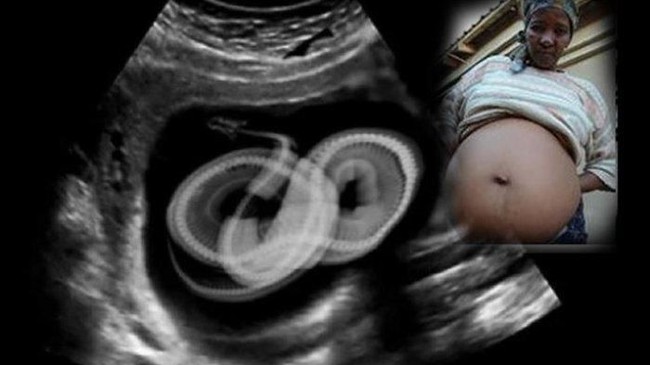 Para Dokter Ini Kaget Temukan Ular hingga Belut Hidup di Perut Pasien