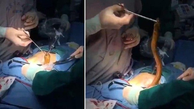 Dokter Temukan Ular dan Belut di Perut Pasien hingga 10 Trik Resto Kelabui Pengunjung.
