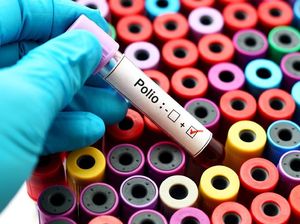 Polio Mendadak Jadi KLB, Kemenkes Ungkap Kemungkinan Sumber Penularannya