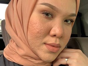 Kisah Inspiratif Selebgram #pejuangjerawat yang Tiap Hari Jerawatan