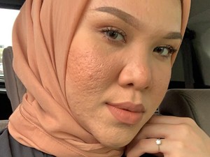 Kisah Inspiratif Selebgram #pejuangjerawat yang Tiap Hari Jerawatan