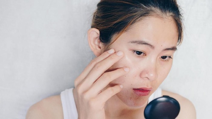 jerawat Conceptual shot of Acne & Problem Skin on female face.