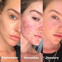 Jerawatnya muncul karena berbagai faktor. Faktor stres karena putus dari pacar, kelelahan karena harus bolak-bali Perth - Los Angeles. Wanita asal Australia itu kemudian didiagnosa mengalami kelelahan kronis yang memicu berbagai penyakit. Foto: Dok. Instagram