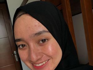 Pelajaran dari Aina Rezeki, Selebgram yang PeDe dengan Wajah Penuh Jerawat