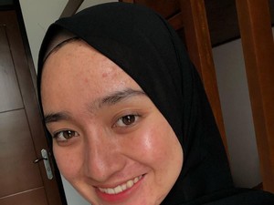 Pelajaran dari Aina Rezeki, Selebgram yang PeDe dengan Wajah Penuh Jerawat