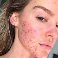 Dalam tiga bulan, kondisi wajahnya sudah mulus kembali. Kepercayaan diri Georgia pun kembali lagi. Pada saat jerawatan. dia mengaku berada di titik terendah karena merasa tak percaya diri, terlebih dengan komentar orang. Foto: Instagram