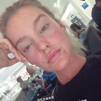 Georgia semakin stres bahkan sampai depresi. Karena hal itulah yang membuat wajahnya jadi berjerawat parah. Foto: Instagram