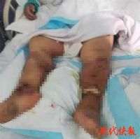 Seram! Kena Cangkang Udang, Pria Ini Terluka Tangannya dan Tewas