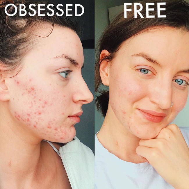 Dalam situsnya, Lea mengatakan dulu ia sangat tidak percaya diri dan menganggap wajahnya jelek hingga tidak mau menanggalkan makeup. Ia pun ingin membagikan metode yang diklaimnya berhasil mengurai masalah kulit itu untuk membantu wanita-wanita lain. Foto: Instagram @skinwithlea