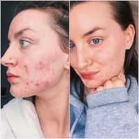 Aku pikir ada banyak perbincangan mengenai produk terbaik selanjutnya dan bagaimana memperbaiki jerawat dengan pelembap xyz atau spot treatment tapi tidak cukup perbincangan mengenai bagaimana pikiranmu mempengaruhinya dan bagaimana semua kebencian diri dan omongan negatif dengan diri sendiri bisa berpengaruhi ke luar, tambahnya. Foto: Instagram @skinwithlea