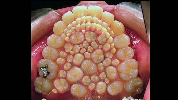 Apakah gambar ini benar menunjukkan mulut dengan kondisi hyperdontia? (Foto: Tangkapan layar viral) Apakah gambar ini benar menunjukkan mulut dengan kondisi hyperdontia? (Foto: Tangkapan layar viral)