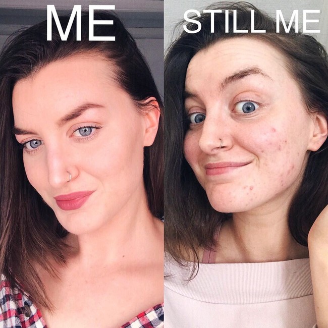 Lea mengaku akan mengajarkan wanita agar tidak perlu menggunakan makeup terus menerus karena malu dengan kulit. Ia pun menawarkan program selama enam minggu untuk membantu wanita  bagaimana mengubah mindset mengenai wajah berjerawat. Foto: Instagram @skinwithlea