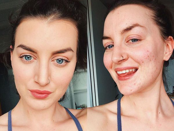 Potret Wanita yang Sembuh dari Jerawatan Parah Hanya dengan Ubah Mindset