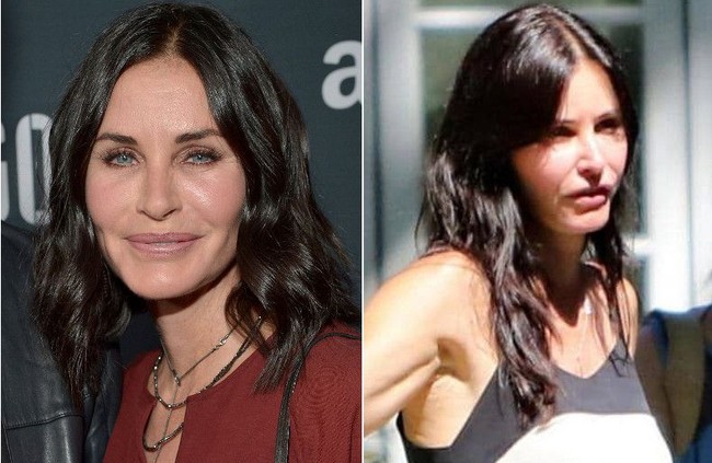 Pada 2012 silam, Courtney Cox pun pernah terlihat dengan wajah bengkak. Tah hanya pipi, namun juga bibir bagian bawahnya tampak lebih bengkak dari biasanya. Diduga bintang Friends itu baru saja melakukan filler. Beberapa tahun setelah, Courtney pu kembali menjadi pemberitaan karena pipinya yang lagi-lagi membengkak. Padahal, dia mengaku bahwa telah berhenti melakukan prosedur botox dan filler.  Foto: Getty Images, Istimewa