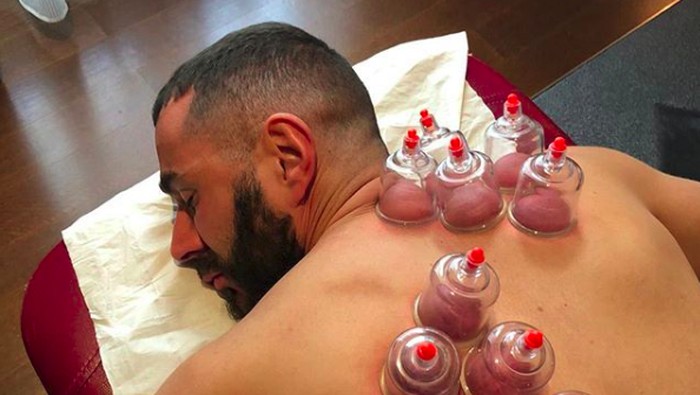 Karim Benzema melakukan terapi bekam. Foto: Instagram/karimbenzema Karim Benzema melakukan terapi bekam. Foto: Instagram/karimbenzema