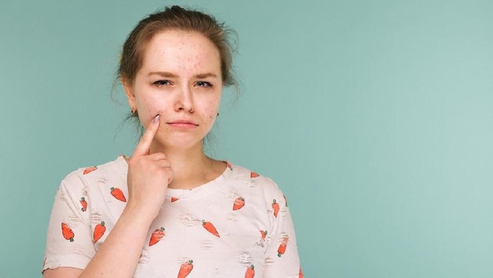 Ternyata, jenis jerawat batu tidak ada dalam dunia medis. Foto ilustrasi: iStock Ternyata, jenis jerawat batu tidak ada dalam dunia medis. Foto ilustrasi: iStock