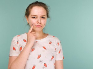 5 Bahan Aktif dalam Produk Skincare yang Ampuh Menghilangkan Jerawat