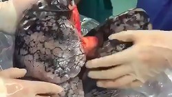 Terpopuler Sepekan: Viral Paru-paru Menghitam Setelah 30 Tahun Merokok Terpopuler Sepekan: Viral Paru-paru Menghitam Setelah 30 Tahun Merokok
