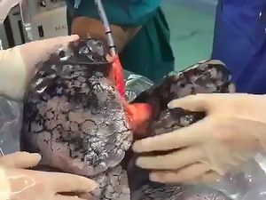 Viral Paru-paru Hitam Akibat Kebiasaan Merokok Selama 30 Tahun