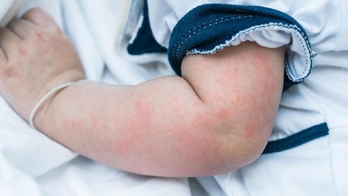 Close up image of baby skin texture suffering severe urticaria, nettle rash.