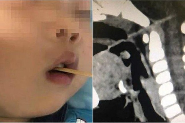 Makanan Terakhir Para Pembunuh Hingga Kejadian Tragis Kecoblos Tusuk Sate