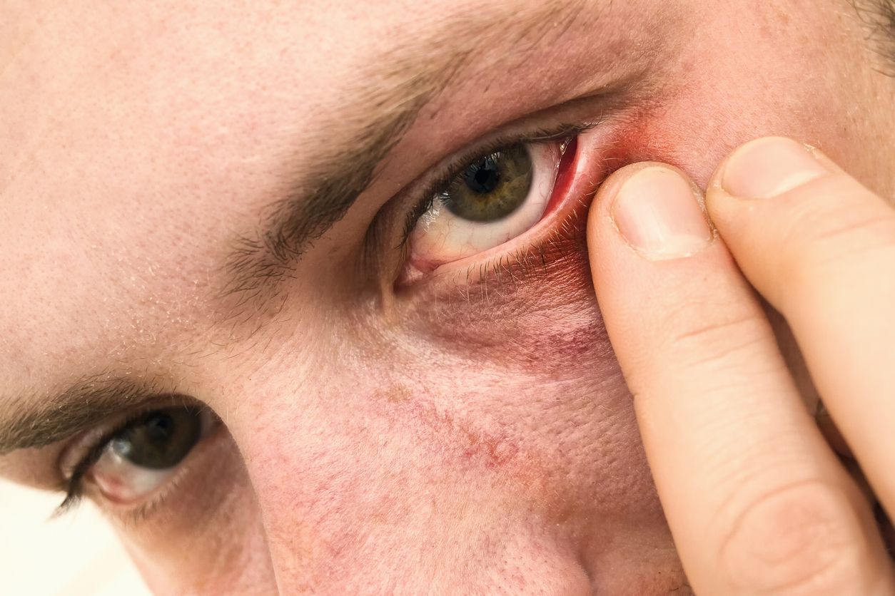 Close up shot of infected eyelid, selective focus[url=https://www.istockphoto.com/search/lightbox/12059314#633a202] [img]http://content22-foto.inbox.lv/albums187686196/grebiss/11-03-2012/eye-stye.jpg[/img][/url]