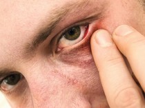 Daftar Obat Mata Alami yang Aman Digunakan