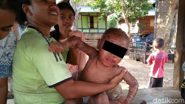 Kondisi genetik langka membuat kulit Fauzan tampak melepuh dan dipenuhi sisik (Foto: Faruk Nickyrawi/detikHealth) Kondisi genetik langka membuat kulit Fauzan tampak melepuh dan dipenuhi sisik (Foto: Faruk Nickyrawi/detikHealth)
