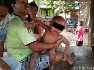 Kelainan Genetik, Sekujur Tubuh Bocah NTB Ini Tampak Melepuh dan Bersisik