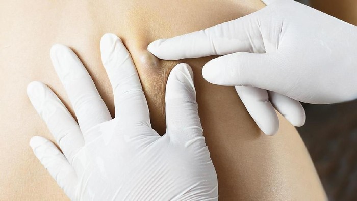 Benjolan di Punggung: Penyebab dan Cara Perawatannya