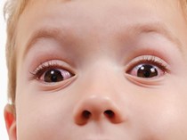 Benarkah Mata Merah pada Anak karena Sering Main HP? Begini Penjelasannya