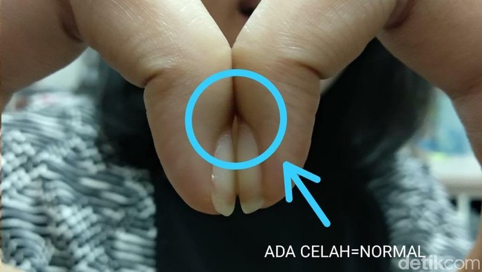 Schamroth window test. Foto: detikHealth Schamroth window test. Foto: detikHealth