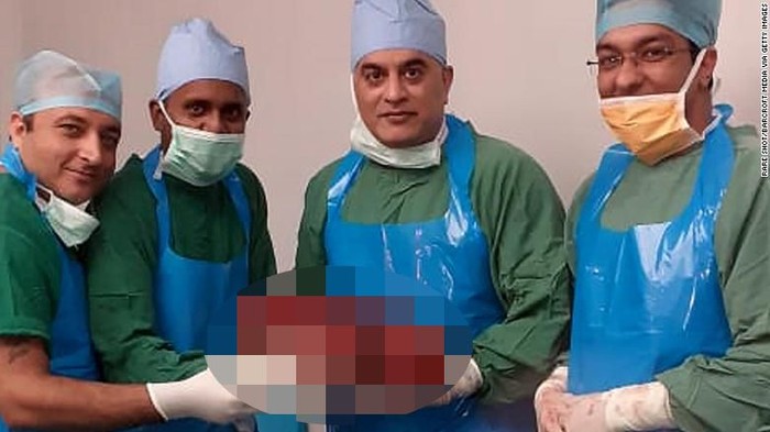 Normalnya ginjal hanya memiliki berat sekitar 130 gram. (Foto: CNN) Normalnya ginjal hanya memiliki berat sekitar 130 gram. (Foto: CNN)
