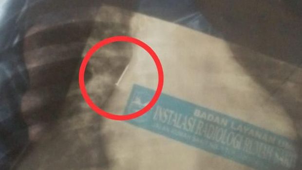 Paku Tertelan Bocah Pangandaran